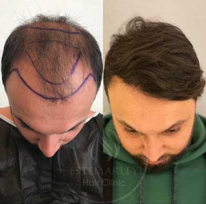 Este Marley | Greffe de Cheveux Turquie | Greffe de Cheveux İstanbul | Hair Transplant Turkey | Haartransplantation main image